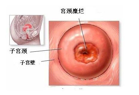 宫颈糜烂